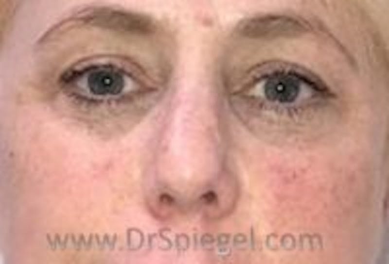 Tear Trough / Under Eye Fillers Before & After Gallery - Patient 407095 - Image 1