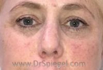 Tear Trough / Under Eye Fillers Before & After Gallery - Patient 407095 - Image 1