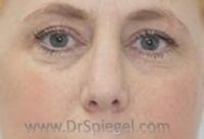 Tear Trough / Under Eye Fillers Before & After Gallery - Patient 407095 - Image 2