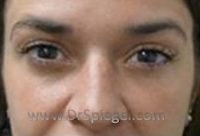 Tear Trough / Under Eye Fillers Before & After Gallery - Patient 244001 - Image 1