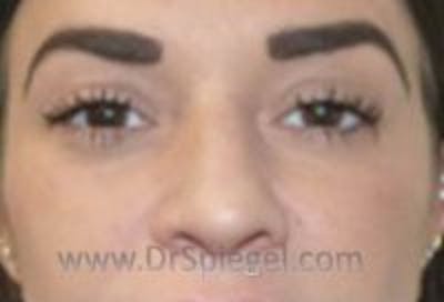 Tear Trough / Under Eye Fillers Before & After Gallery - Patient 244001 - Image 2