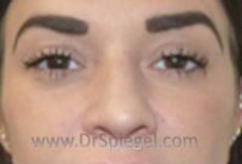 Tear Trough / Under Eye Fillers Before & After Gallery - Patient 244001 - Image 2