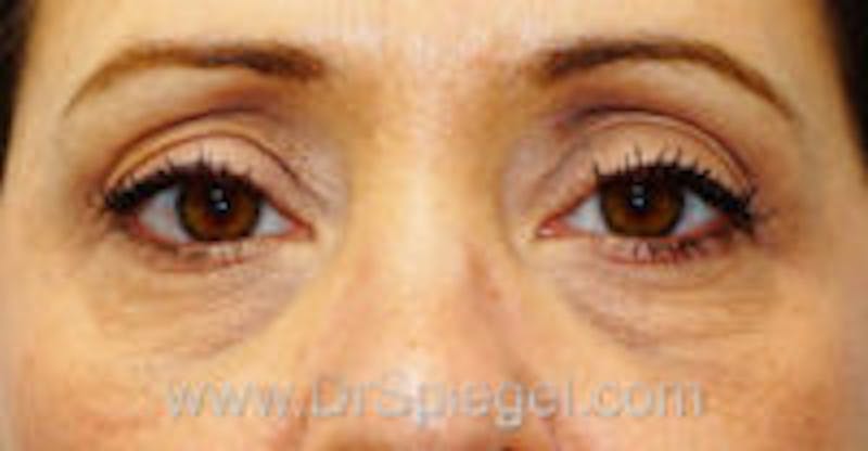 Tear Trough / Under Eye Fillers Before & After Gallery - Patient 197262 - Image 1