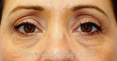 Tear Trough / Under Eye Fillers Before & After Gallery - Patient 197262 - Image 1