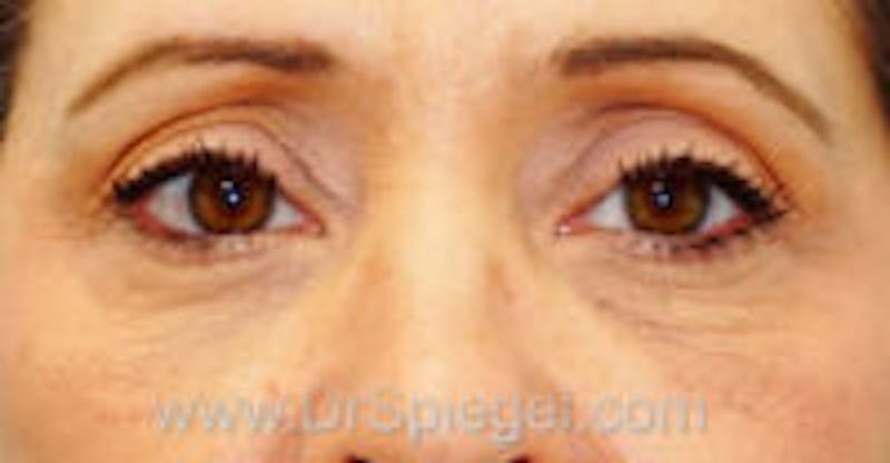 Tear Trough / Under Eye Fillers Before & After Gallery - Patient 197262 - Image 2