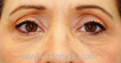 Tear Trough / Under Eye Fillers Before & After Gallery - Patient 197262 - Image 2