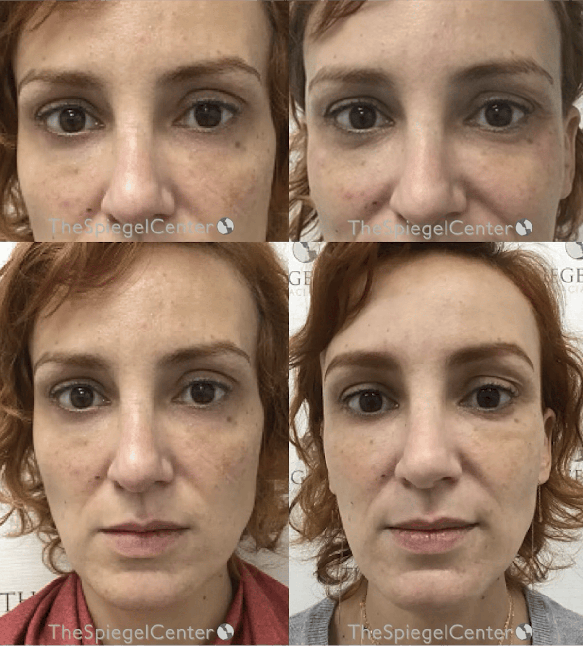 Temple Filler Before & After Gallery - Patient 326486 - Image 1