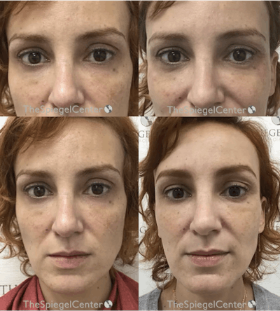 Temple Filler Before & After Gallery - Patient 326486 - Image 1