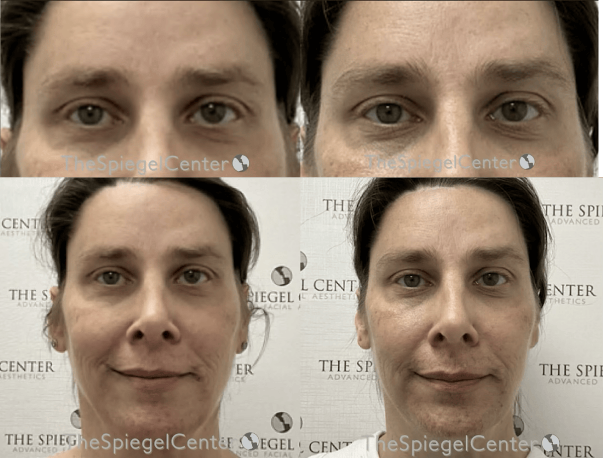Temple Filler Before & After Gallery - Patient 376119 - Image 1