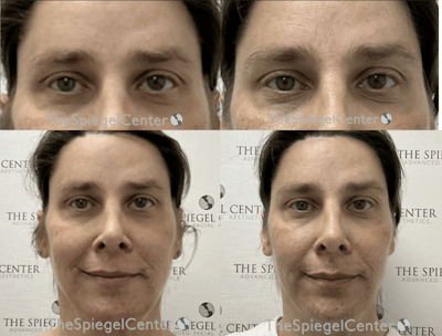 Temple Filler Before & After Gallery - Patient 376119 - Image 1