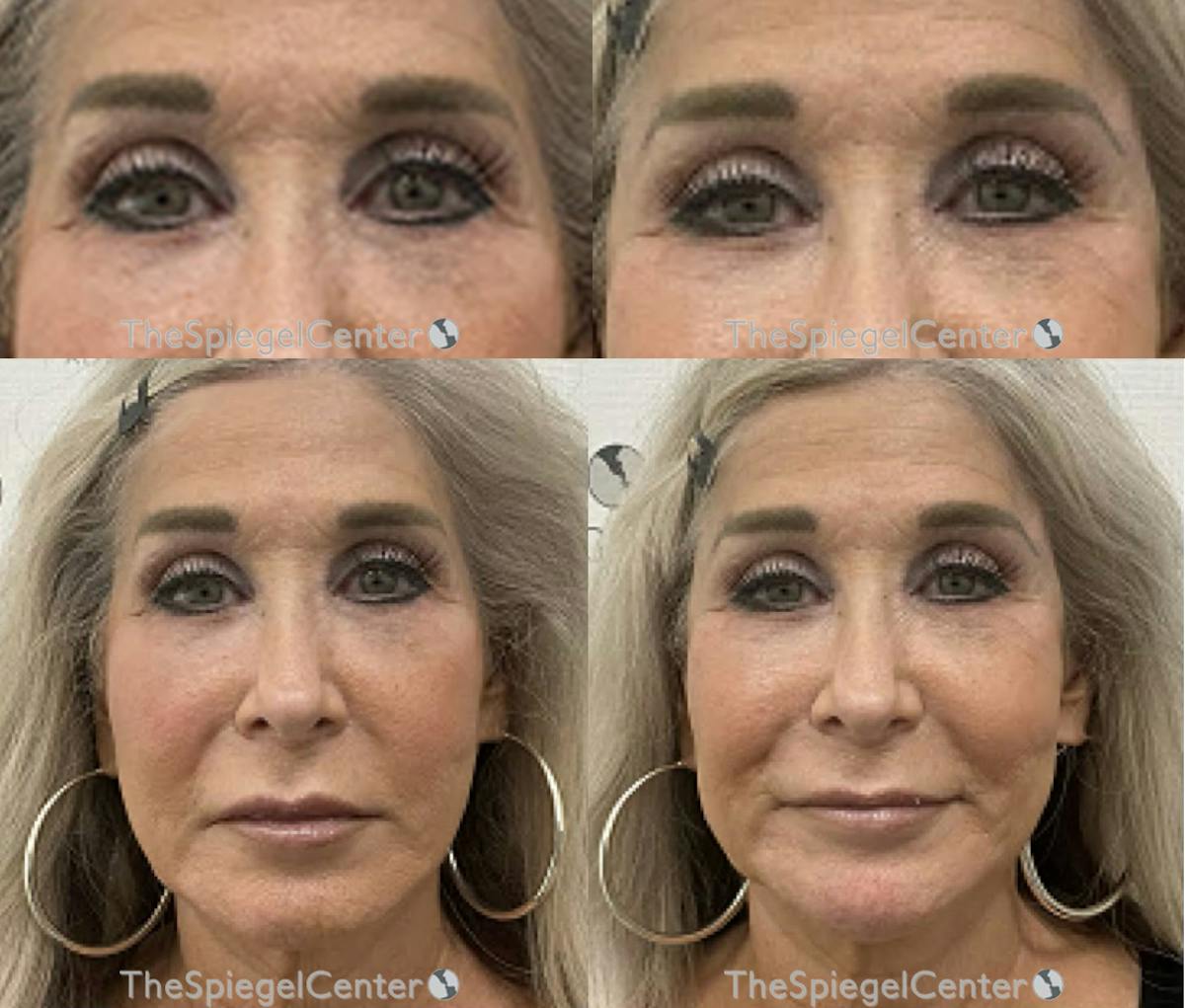 Temple Filler Before & After Gallery - Patient 417923 - Image 1