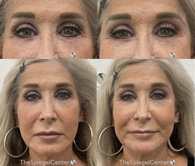 Temple Filler Before & After Gallery - Patient 417923 - Image 1