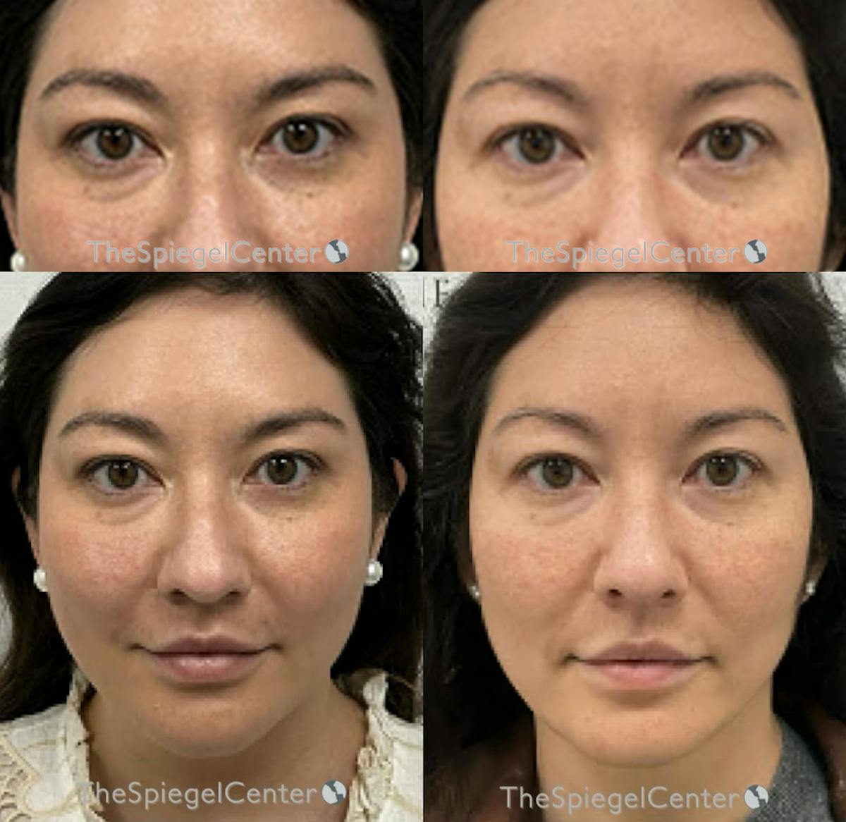 Temple Filler Before & After Gallery - Patient 283397 - Image 1
