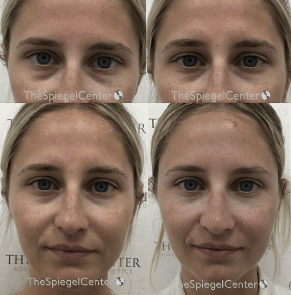 Temple Filler Before & After Gallery - Patient 391694 - Image 1