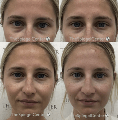 Temple Filler Before & After Gallery - Patient 391694 - Image 1