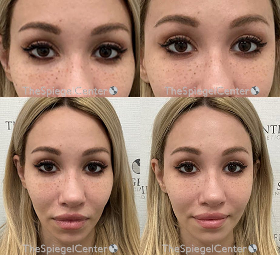 Temple Filler Before & After Gallery - Patient 254655 - Image 1
