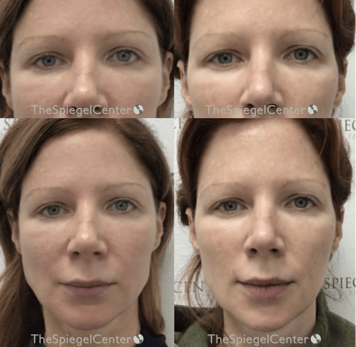 Temple Filler Before & After Gallery - Patient 125564 - Image 1