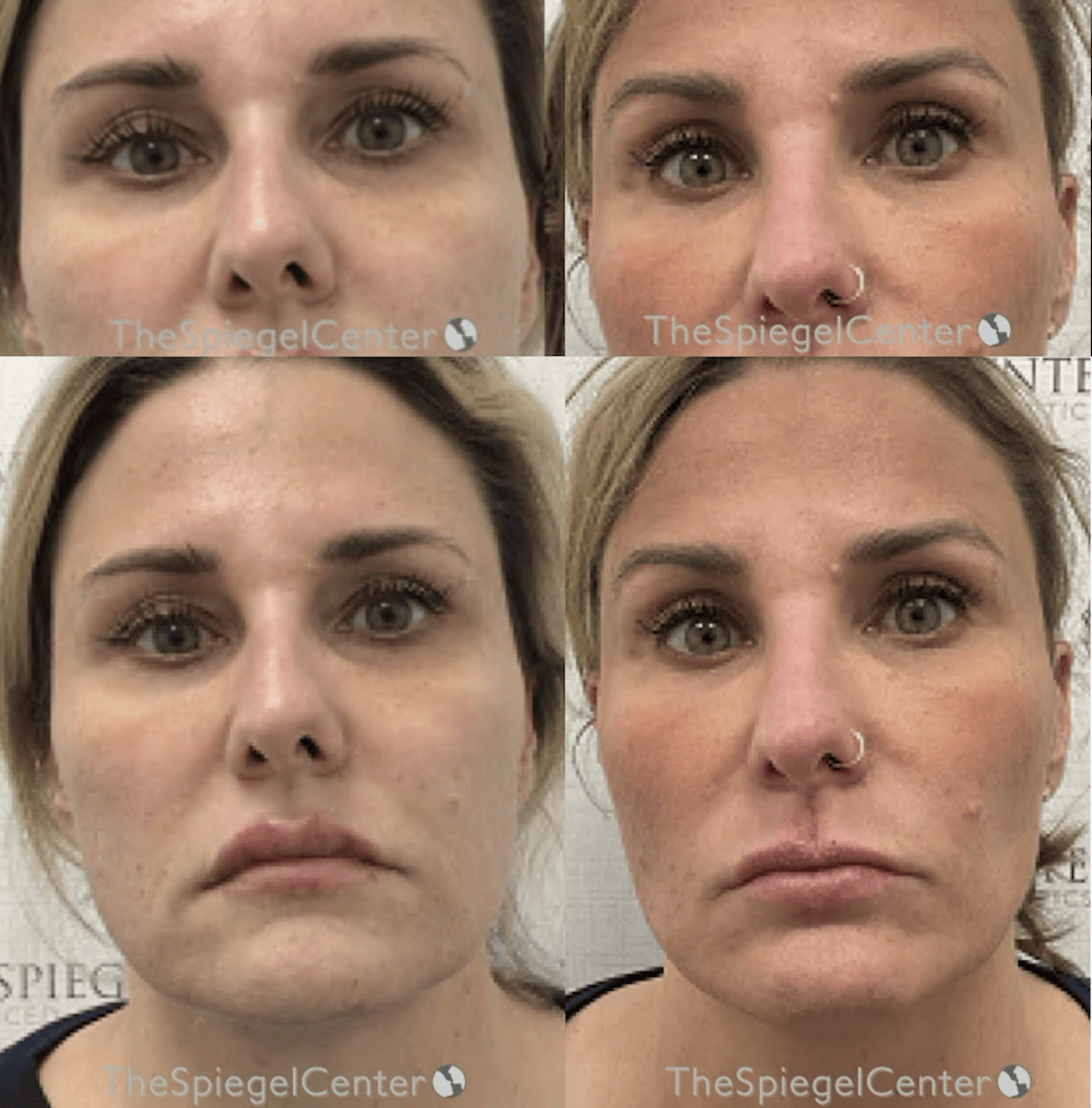 Temple Filler Before & After Gallery - Patient 311307 - Image 1