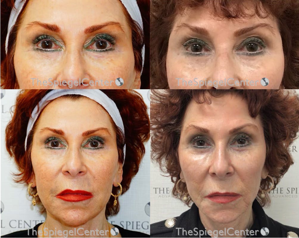 Temple Filler Before & After Gallery - Patient 275797 - Image 1