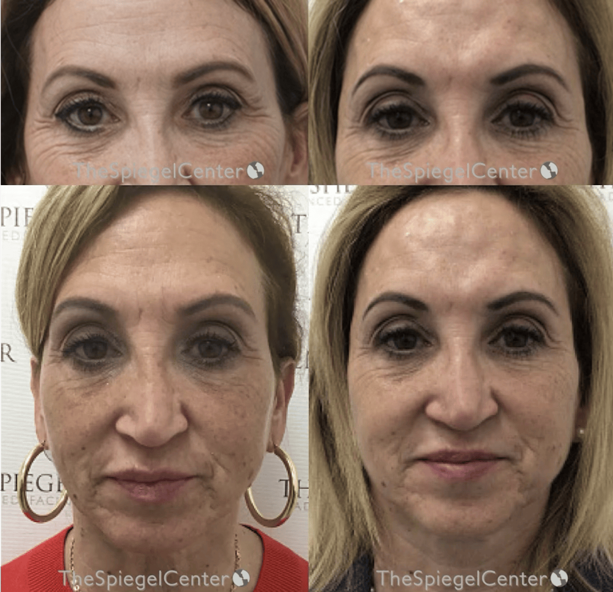Temple Filler Before & After Gallery - Patient 256030 - Image 1