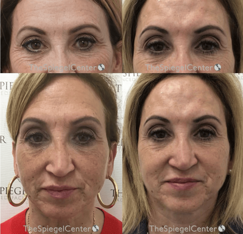Temple Filler Before & After Gallery - Patient 256030 - Image 1
