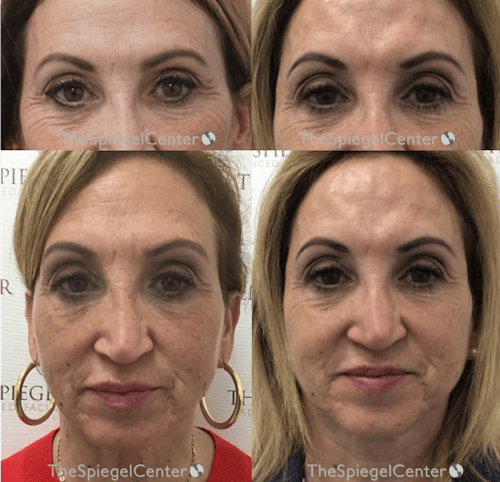 Temple Filler Before & After Gallery - Patient 256030 - Image 1