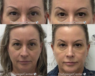 Temple Filler Before & After Gallery - Patient 288381 - Image 1