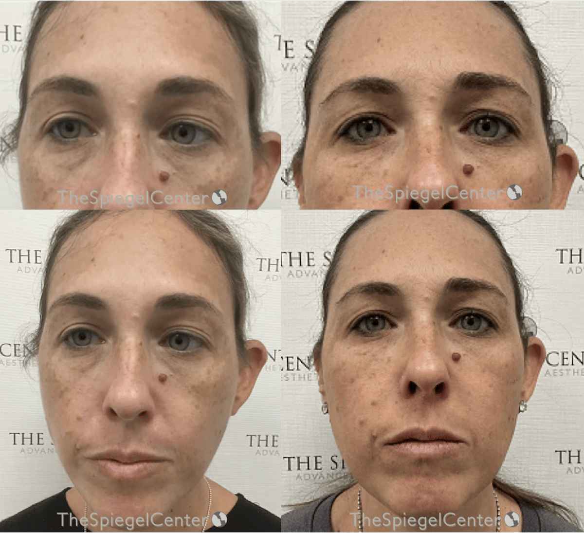 Temple Filler Before & After Gallery - Patient 263804 - Image 1