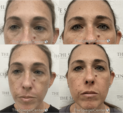 Temple Filler Before & After Gallery - Patient 263804 - Image 1