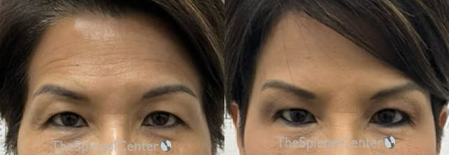Temple Filler Before & After Gallery - Patient 340566 - Image 1