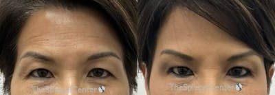 Temple Filler Before & After Gallery - Patient 340566 - Image 1