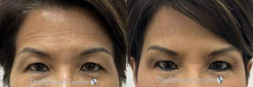 Temple Filler Before & After Gallery - Patient 340566 - Image 1