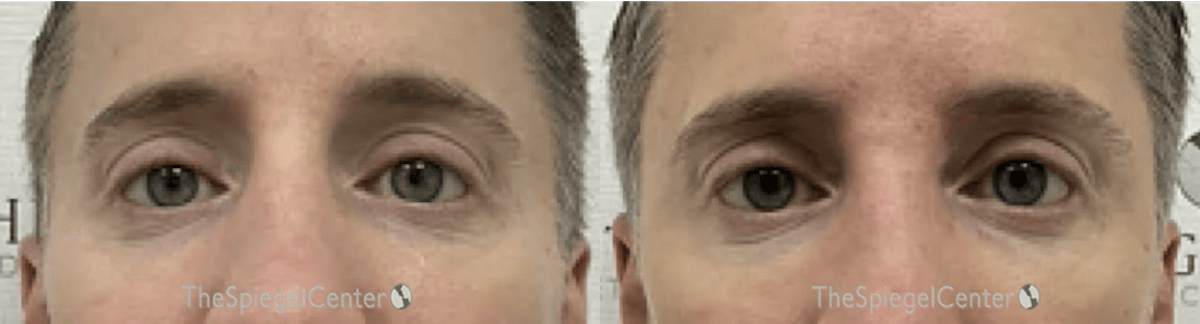 Temple Filler Before & After Gallery - Patient 287468 - Image 1