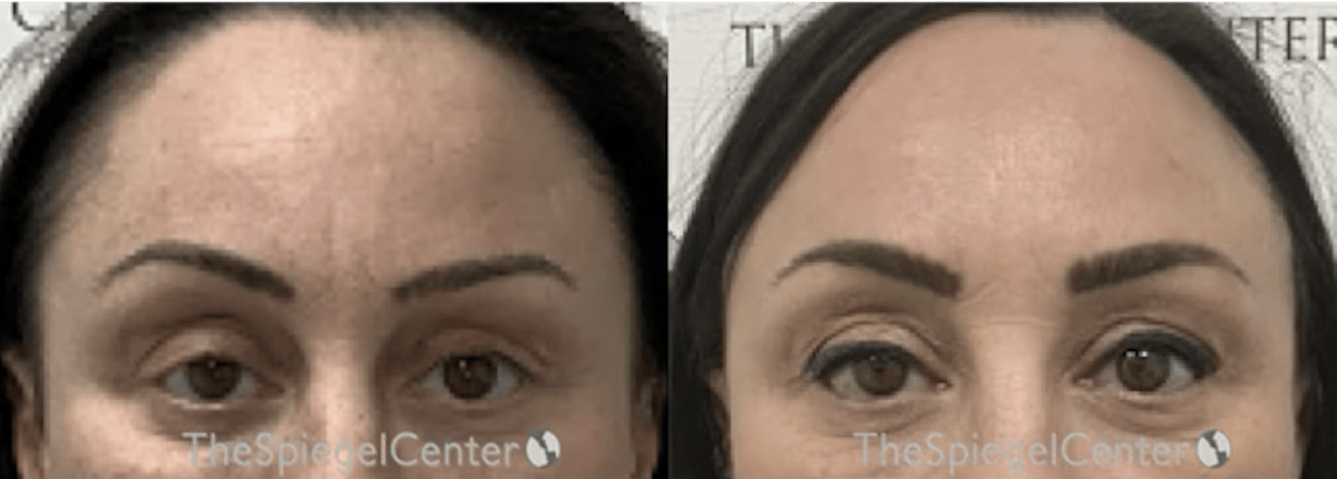 Temple Filler Before & After Gallery - Patient 399105 - Image 1