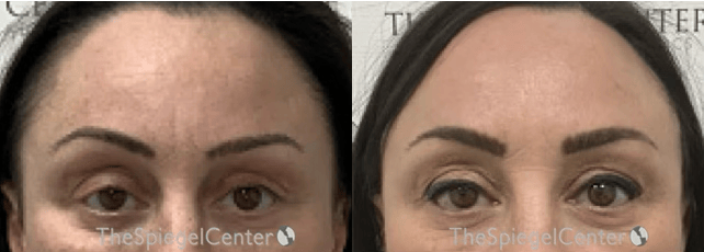 Temple Filler Before & After Gallery - Patient 399105 - Image 1