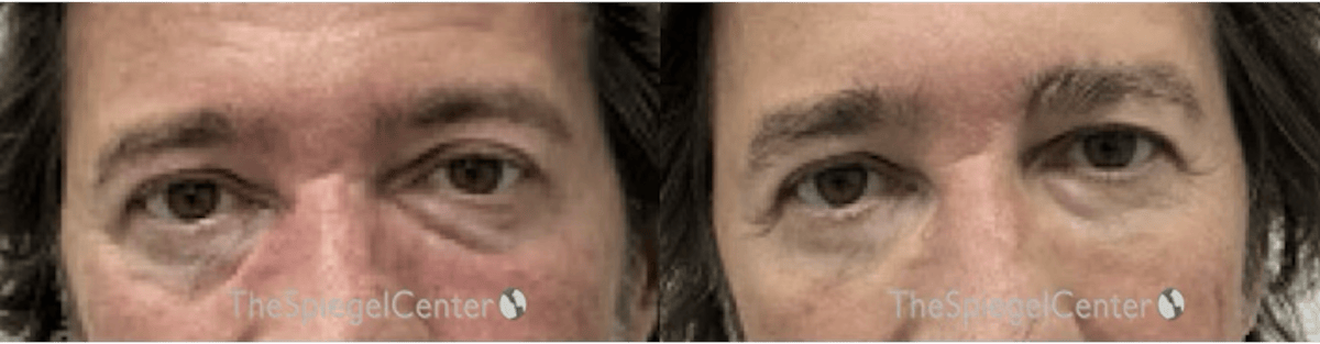 Temple Filler Before & After Gallery - Patient 370653 - Image 1