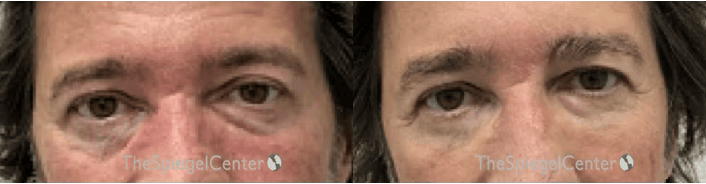Temple Filler Before & After Gallery - Patient 370653 - Image 1