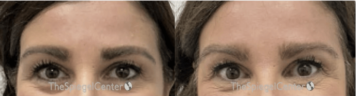 Temple Filler Before & After Gallery - Patient 365859 - Image 1