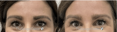 Temple Filler Before & After Gallery - Patient 365859 - Image 1