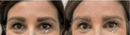 Temple Filler Before & After Gallery - Patient 365859 - Image 1