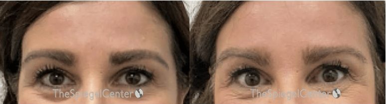 Temple Filler Before & After Gallery - Patient 365859 - Image 1