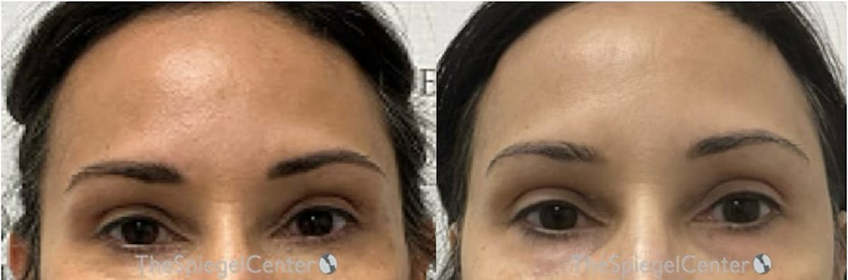 Temple Filler Before & After Gallery - Patient 771368 - Image 1