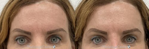 Temple Filler Before & After Gallery - Patient 270965 - Image 1