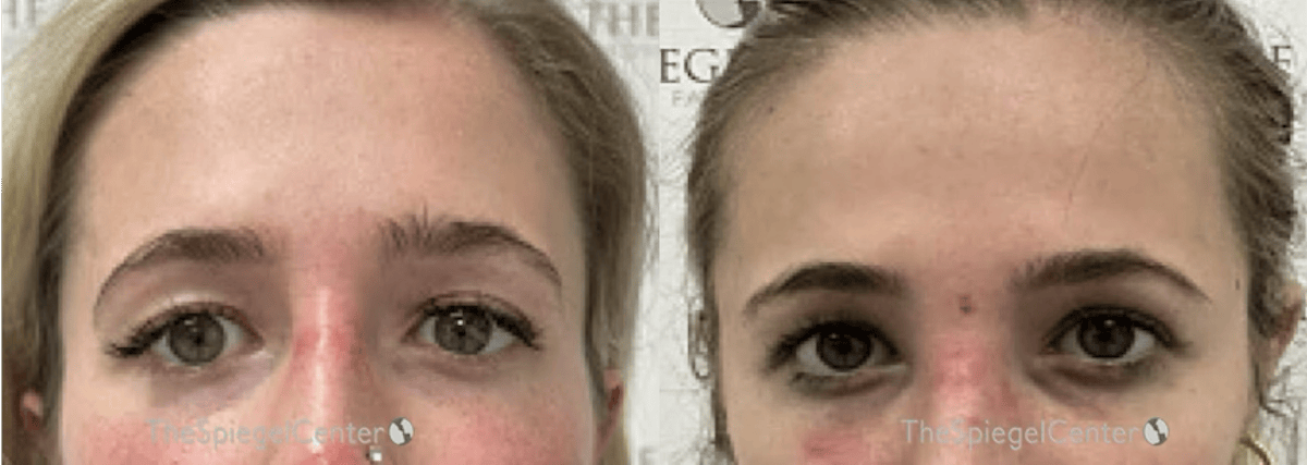 Temple Filler Before & After Gallery - Patient 295575 - Image 1