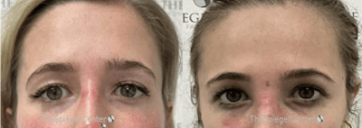 Temple Filler Before & After Gallery - Patient 295575 - Image 1