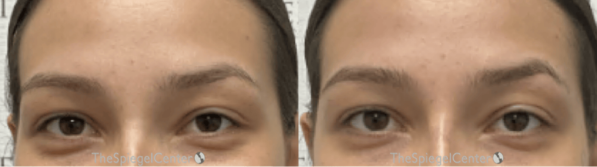 Temple Filler Before & After Gallery - Patient 371592 - Image 1