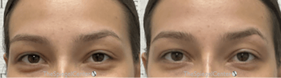 Temple Filler Before & After Gallery - Patient 371592 - Image 1