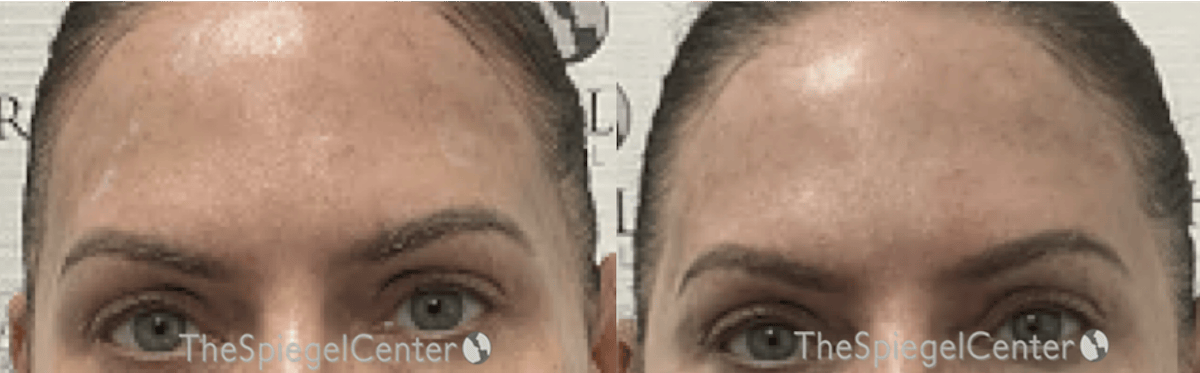 Temple Filler Before & After Gallery - Patient 187226 - Image 1