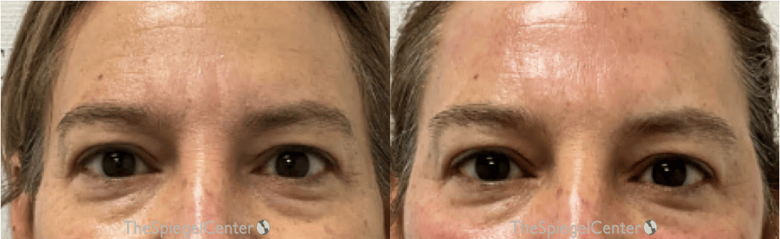 Temple Filler Before & After Gallery - Patient 288633 - Image 1