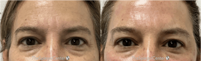 Temple Filler Before & After Gallery - Patient 288633 - Image 1